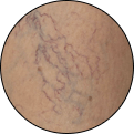 Varices y trombosis